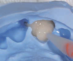 Luxatemp PLUS - внесение пластмассы